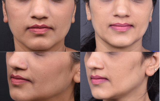 Skin Treatment Before After